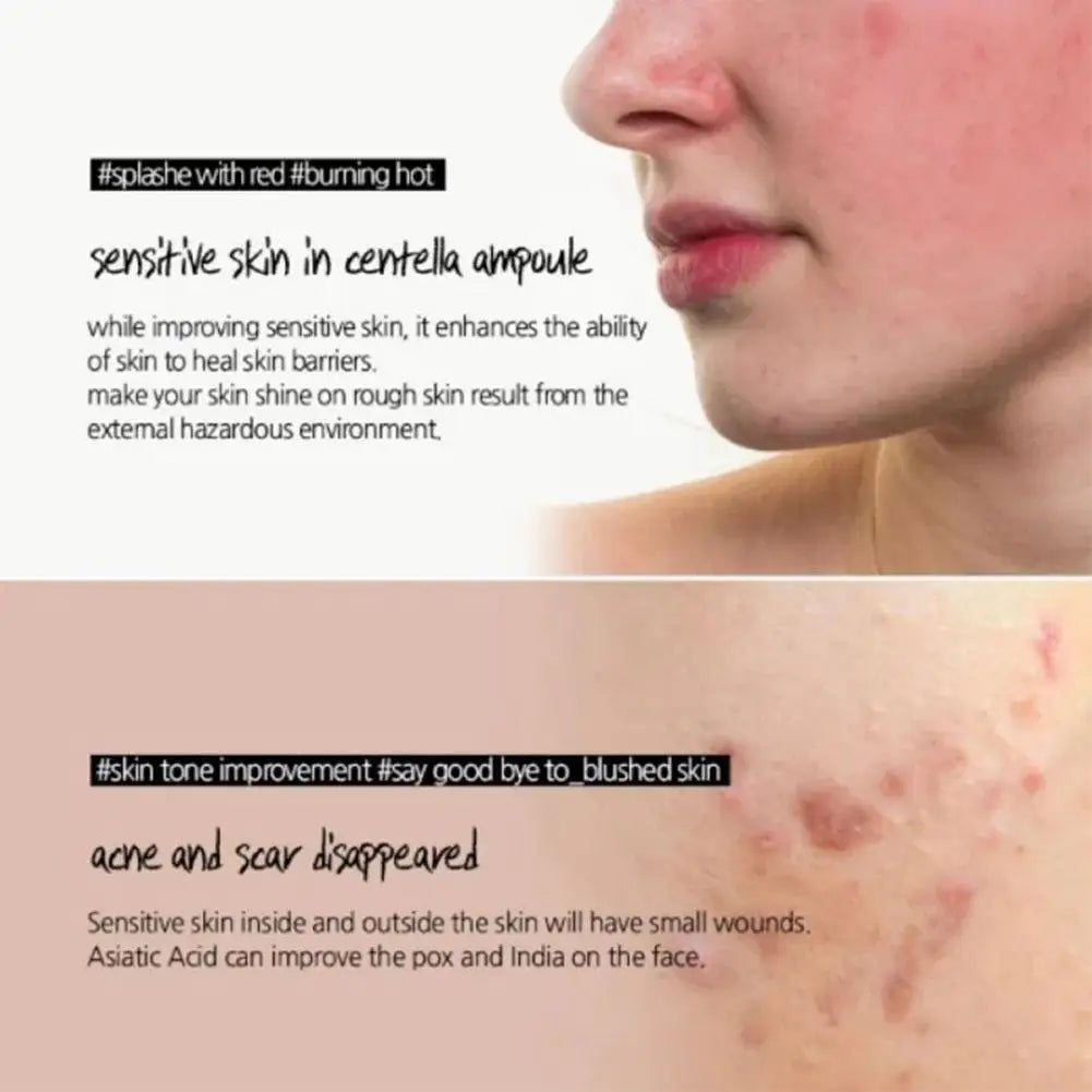 Veganskincare, Centella , Skin 1004 Madagascar , Moisturizing Essence Moisturizing Water Repair Relieve Acne Brighten Skin Wrinkle Removal Anti-Aging